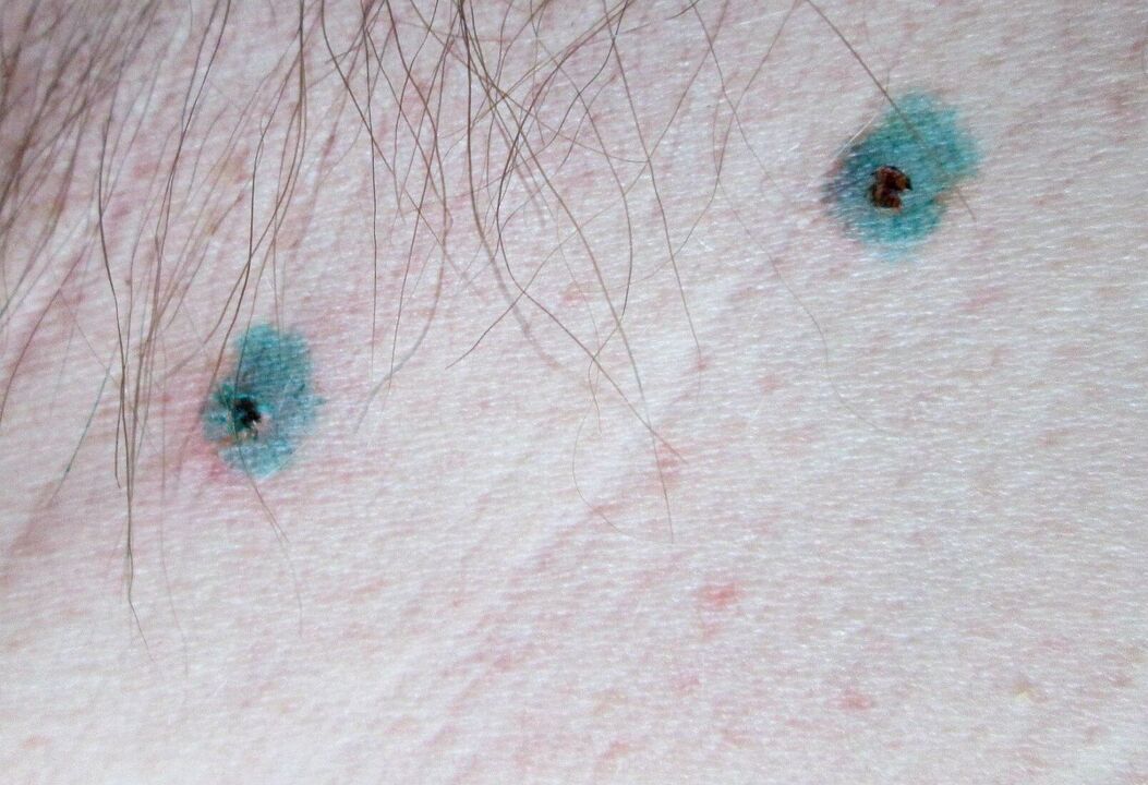 Märgid nahal pärast papilloomide lasereemaldust